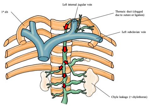 Postoperative Chylothorax after Modified Radical Neck Dissection for