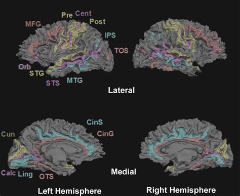 Multimodal Surface Based Morphometry Reveals Diffuse Cortical Atrophy