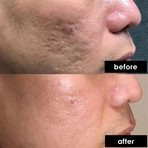 Best Acne Scar Laser Regalion Clinic Kota Damansara