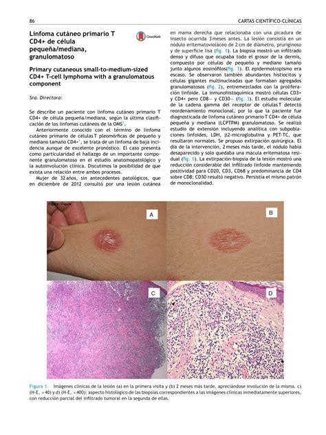 Pdf Primary Cutaneous Small To Medium Sized Cd T Cell Lymphoma With