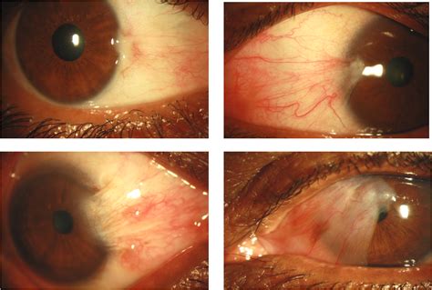 Pterygium Treatment Surgery Vibrant Eye Care