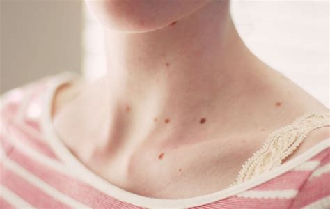 Photos of Moles on Face and Neck ~ How To Remove Moles, Warts, Skin ...