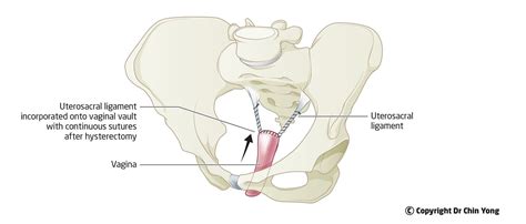 Post Hysterectomy Vault Prolapse Surgery — Dr Chin Yong