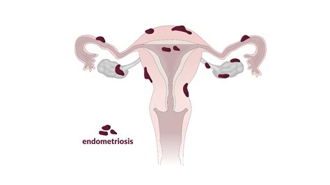 Endométriose Causes symptômes et traitement Gravida