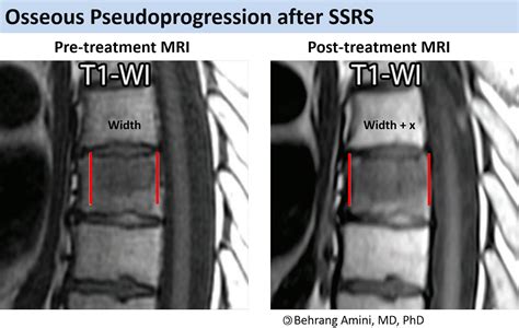 Roentgen Ray Reader Osseous Pseudoprogression After Spine Stereotactic