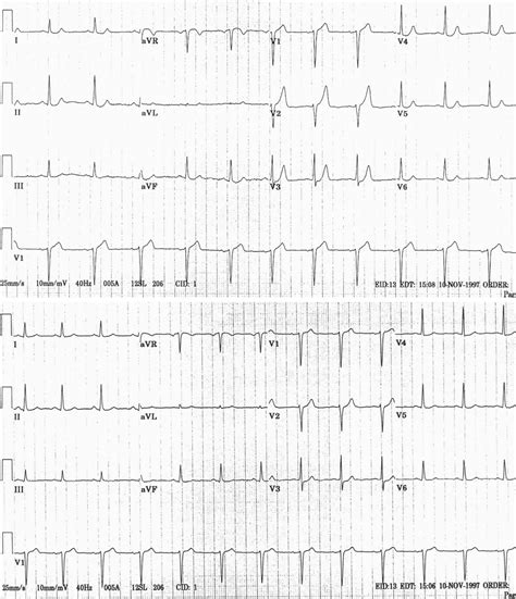 Ekg Part 7 Elevasi Segmen St Dan Penemuan Lain Pada Infark Miokard Difusi Review