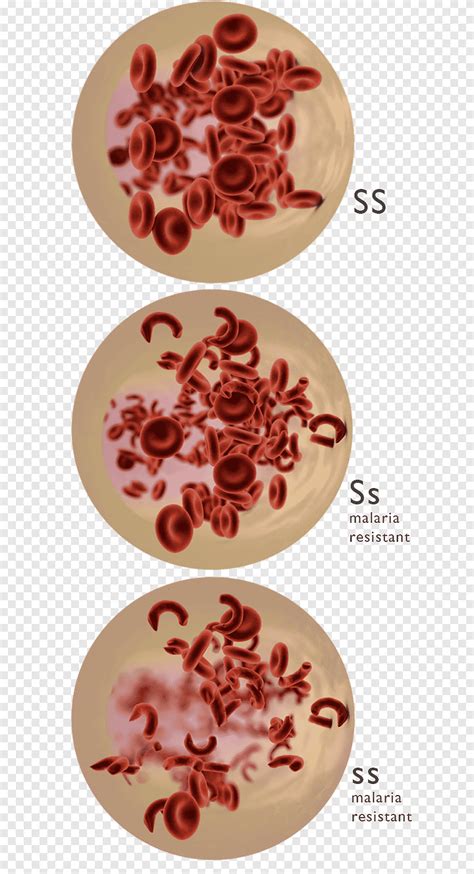 Codominance Sickle Cell Disease Genetic Disorder Genetics Red Blood