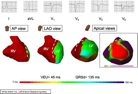 Nonspecific Intraventricular Conduction Delay Definitions Prognosis