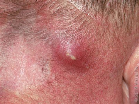 Is It Safe To Drain An Abscess At Home Goodrx