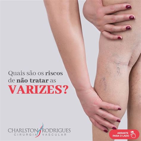 Classificação de varizes Dr Charlston Rodrigues