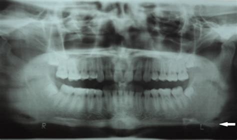 Opg Shows Bone Spurs At Angle Of Mandible White Arrow Download Scientific Diagram