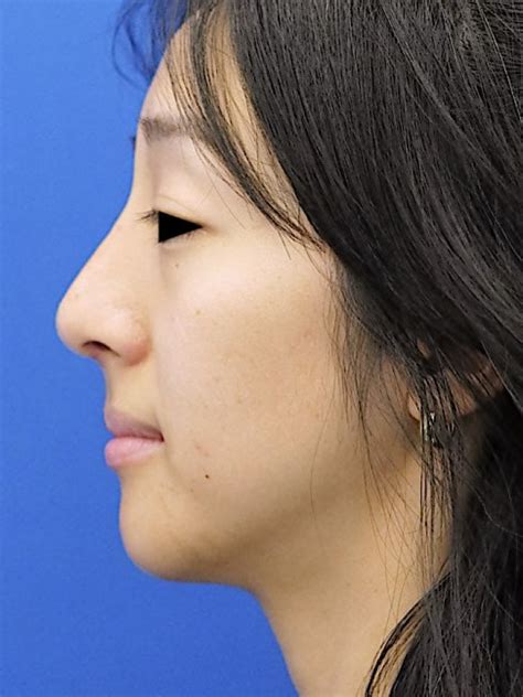 Preservation Ethnic Rhinoplasty 6808