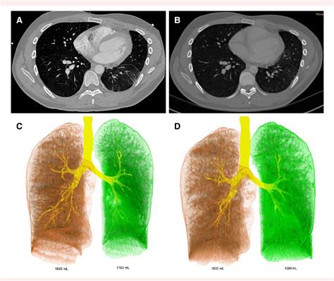 Figure 1 From Partially Reversible Lung Consolidation After Revascularization Of A Total