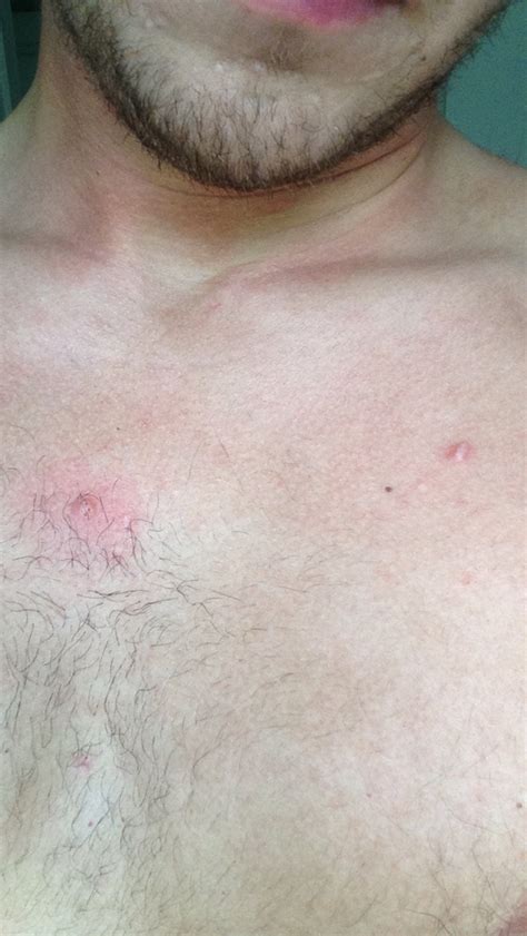 Acne Bumps On Chest