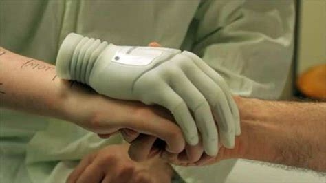 Man Undergoes Elective Amputation To Get A Robotic Arm