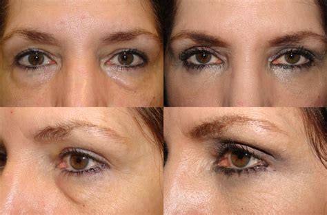 The Art Of Lower Blepharoplasty It Requires A Specialist With Experience And Expertise