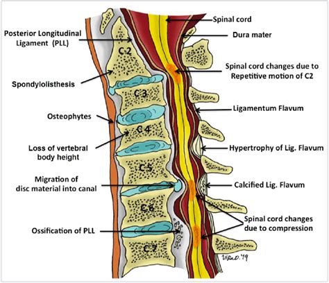 Ossification Of The Posterior Longitudinal Ligament Opll Amara Pain And Spine Management