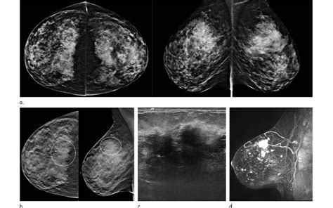 Tomosynthesis-Versus-Digital-Mammography | RSNA