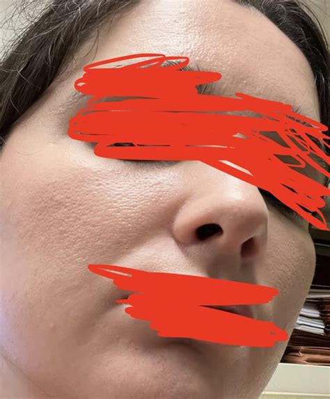 Orange Peel Skin Texture Info In Comments [routine Help] R