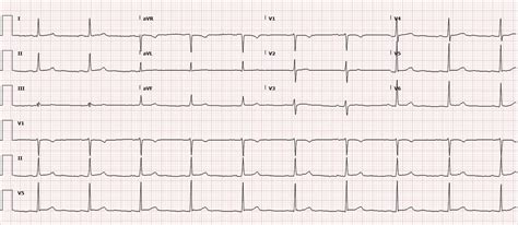 Inferolateral St Elevation Atypical Presentation Or Stemi Mimic