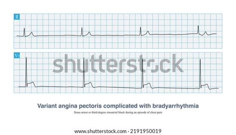 Rythme D Chappement Jonctionnel Images Stock Photos D Objects