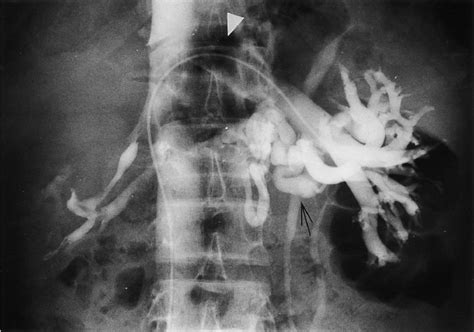 Renal Phlebography Arrowhead Shows Obstruction Of Left Renal Venous