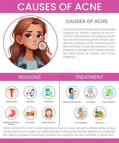 Causes Of Acne Infographic Cause And Treatment Of Acne Editable Vector