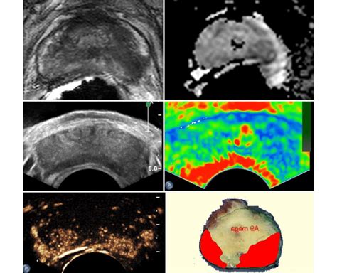 Multiparametric Ultrasound And Mri Modalities Top Left And Right