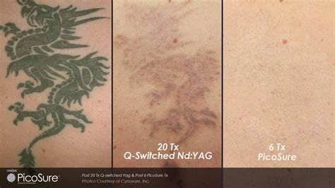 Laser Tattoo Removal Before After Photos Allergy Skin Spa