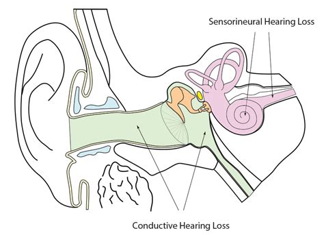 Hearing loss | enteducationswansea