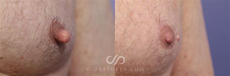 Male Nipple Reduction Before And After Photo Gallery Los Angeles CA