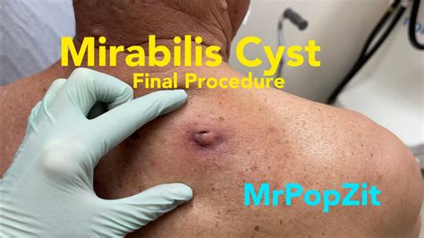 Final Procedure Giant Proteus Mirabilis Abscessinfected Cyst Cyst