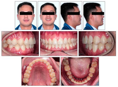 Class Iii Malocclusion Treatment Options Mariano Guillory