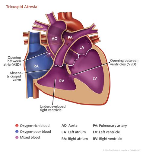 Tricuspid Atresia | Children's Hospital of Philadelphia