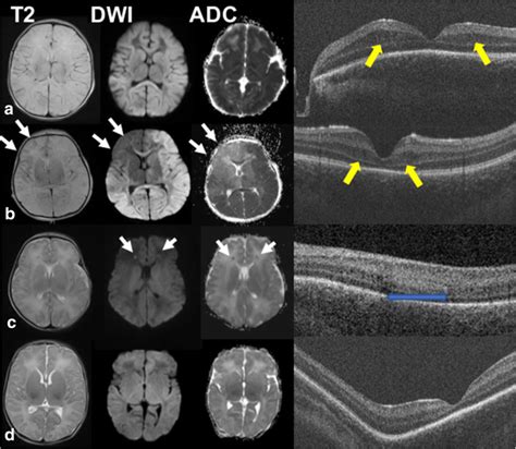 Representative Magnetic Resonance Imaging Mri T2 Images