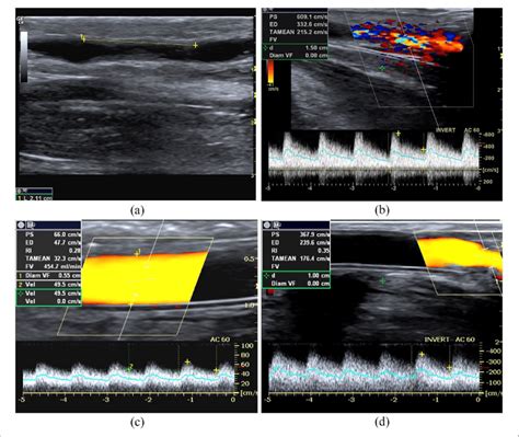 Outflow Stenosis A B Mode Image Of An Iuxta Anastomotic Tract Of A