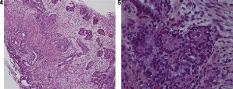 Well Differentiated Fetal Adenocarcinoma A Very Uncommon Malignant