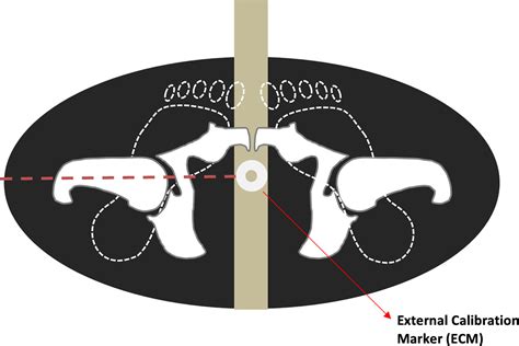 Pre‐operative Templating For Total Hip Arthroplasty How Does