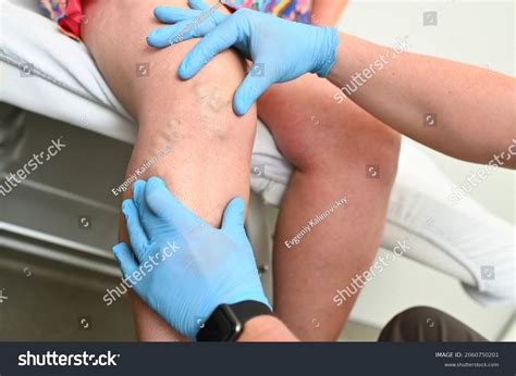 Phlebologist Examines Patient Varicose Veins On Stock Photo