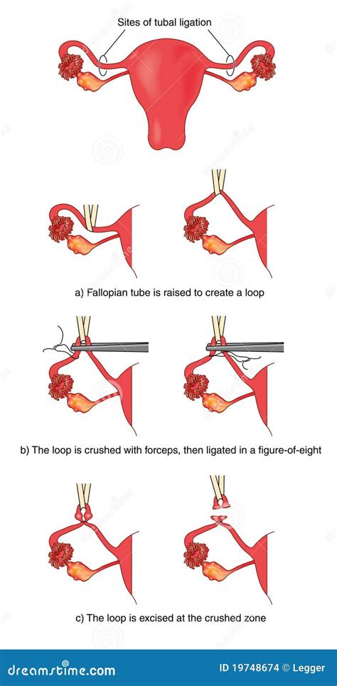 Fallopian tube ligation stock vector. Image of science - 19748674