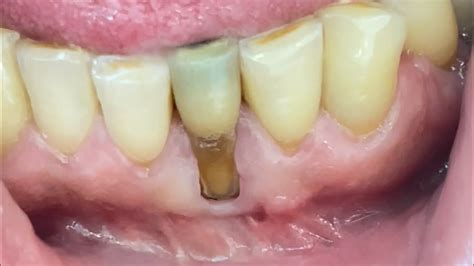 Bone Dehiscence Bone Lost Gum Recession Youtube