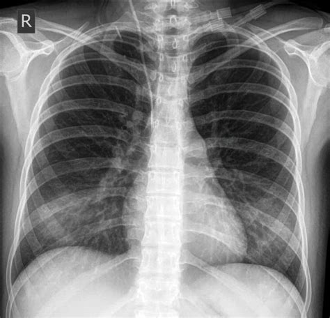 Upright Chest X Ray Showing The Central Venous Catheter Arrow L | The ...