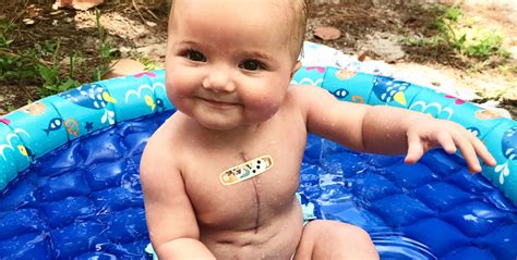 Beach Baby Uf Health Congenital Heart Center Gives Young Riley Chance