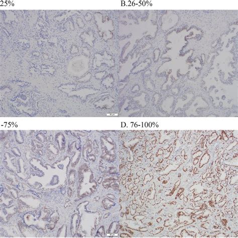 Representative Immunostaining Showing Examples Of Prostate Tumors With