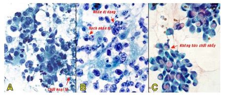 Fine Needle Aspiration Cytology Fna Mammary Gland Lesions Vinmec