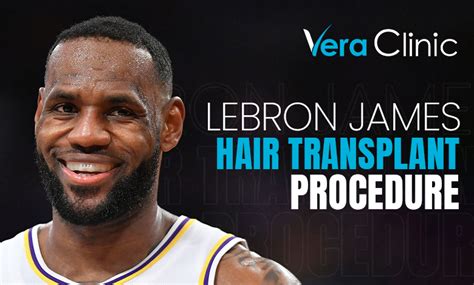 LeBron James Hair Transplant - Vera Clinic