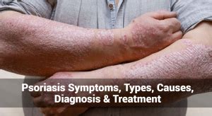 Psoriasis Symptoms Types Causes Diagnosis Treatment Eczemaless