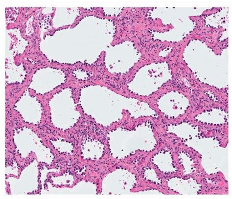 Atypical Adenomatous Hyperplasia Adenocarcinoma In Situ And Minimally Invasive Adenocarcinoma