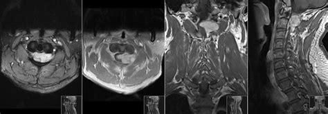 Radiology Mri Spinal Neurinoma