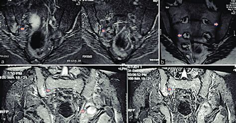 Patient 2 A And B Acute Right Sacroiliitis With Effusion On Stir A Download Scientific